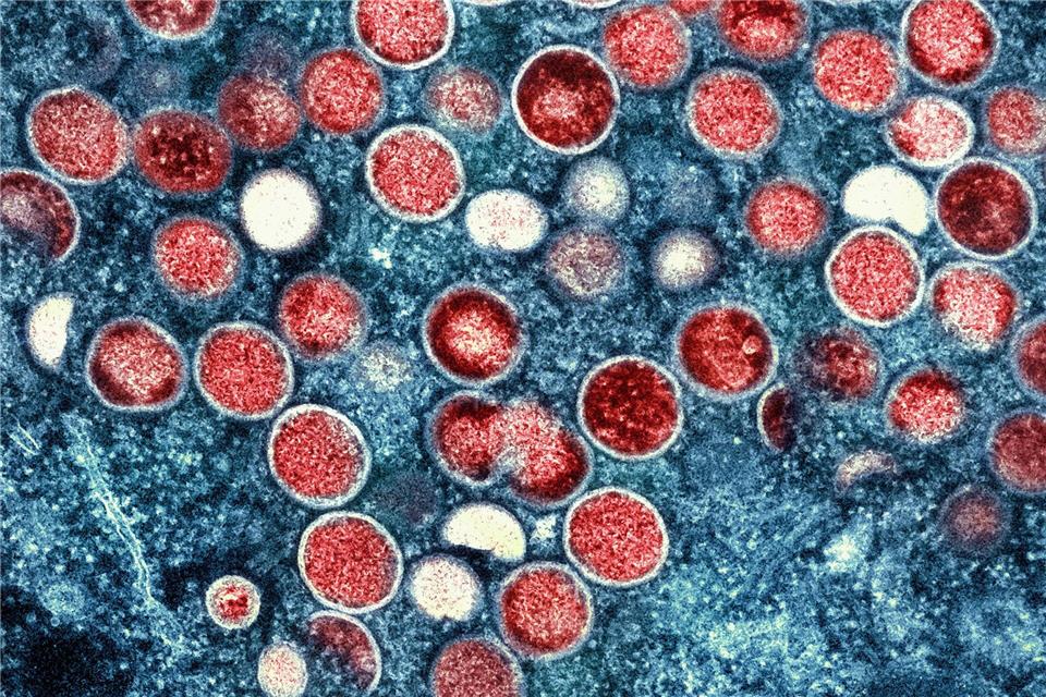  Beim Menschen wurden Mpox erstmals 1970 in der Demokratischen Republik Kongo identifiziert (Symbolbild).-/National Institute of Allergy and Infectious Diseases/dpa