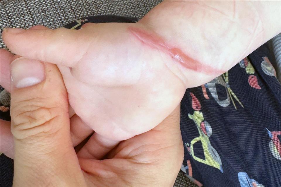 Bei Verbrennungen zweiten Grades zeigen sich Brandblasen, die nicht aufgestochen werden sollten.Till Simon Nagel/dpa-tmn