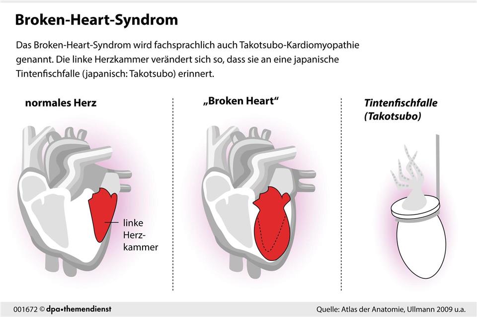 Das Broken-Heart-Syndrom erinnert an einen Herzinfarkt. Tatsächlich verändert sich dabei aber vor allem die linke Herzkammer. dpa-infografik/dpa-tmn