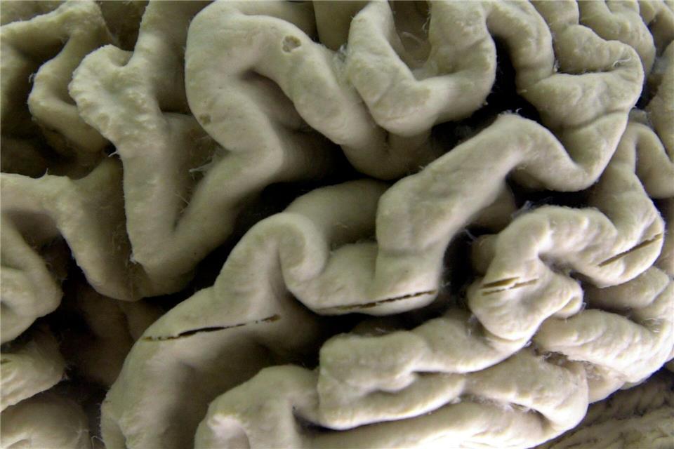 Das Gehirn eines Alzheimer-Patienten zeigt tiefe Furchen. (Illustration)David Duprey/AP/dpa