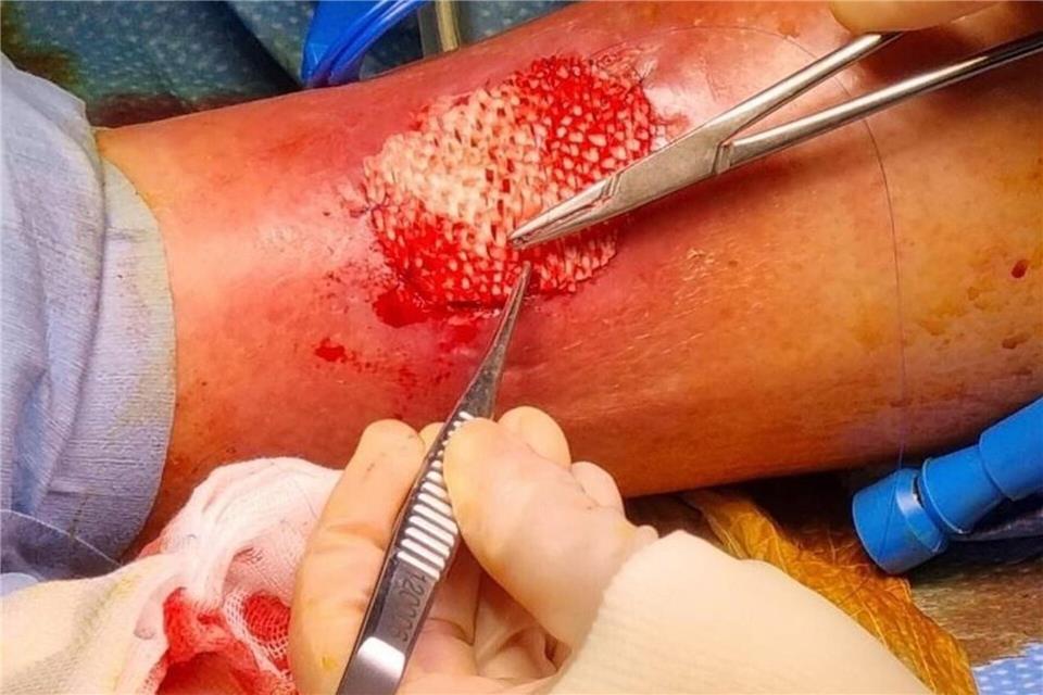 Das Omega-3 in der Fischhaut fördert die Heilung großer Wunden. Saziye Karaca/-/dpa