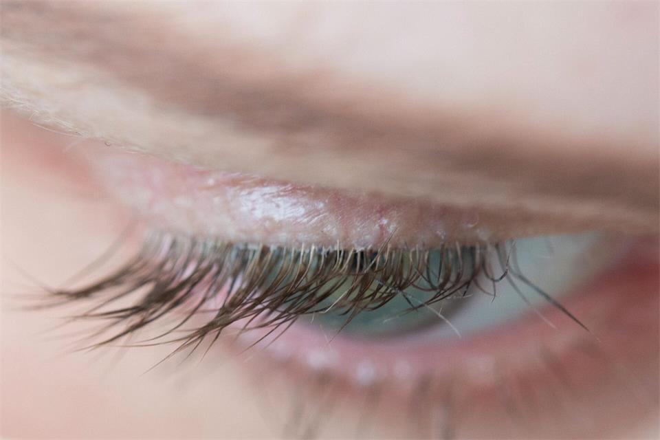 Demodex-Milben können Symptome eines trockenen Auges oder einer Lidrandentzündung auslösen.Andrea Warnecke/dpa-tmn