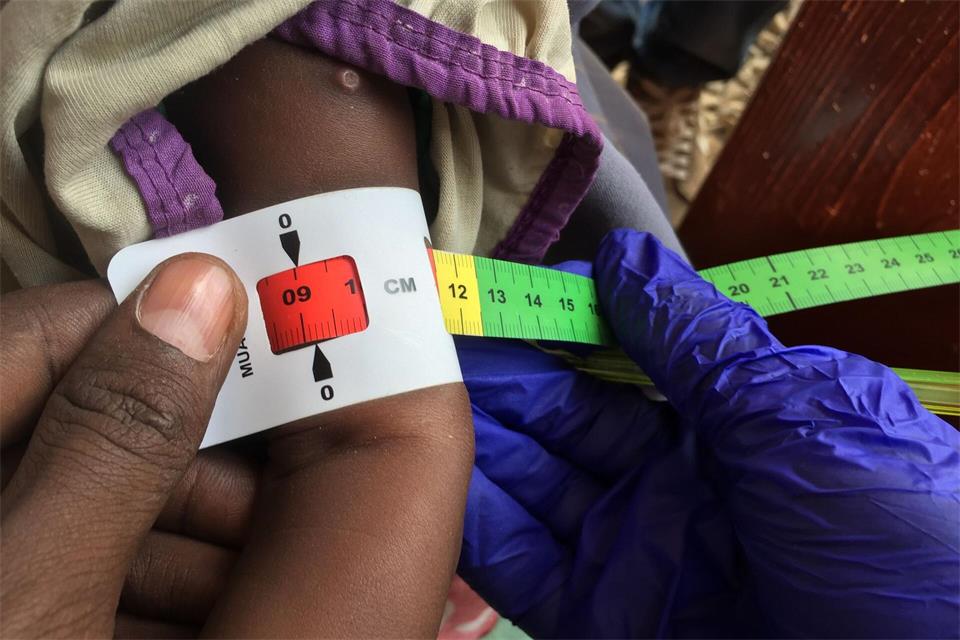 Ein Arzt misst den Armumfang eines unterernährten Babys. Mehr als die Hälfte der Bevölkerung in Somalia ist chronisch unterernährt. (Archivbild) Eva-Maria Krafczyk/dpa