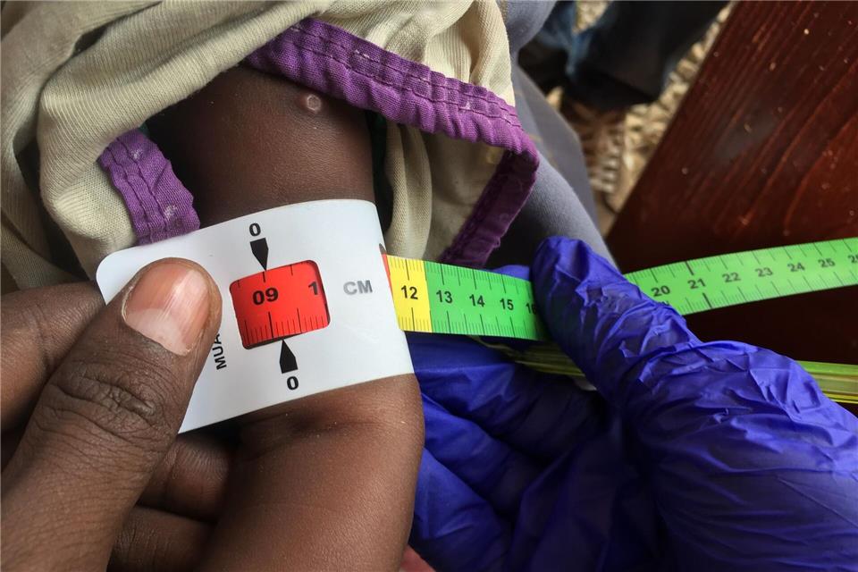 Ein Arzt misst im Sudan den Armumfang eines schwer unterernährten Babys (Archivbild)Eva-Maria Krafczyk/dpa