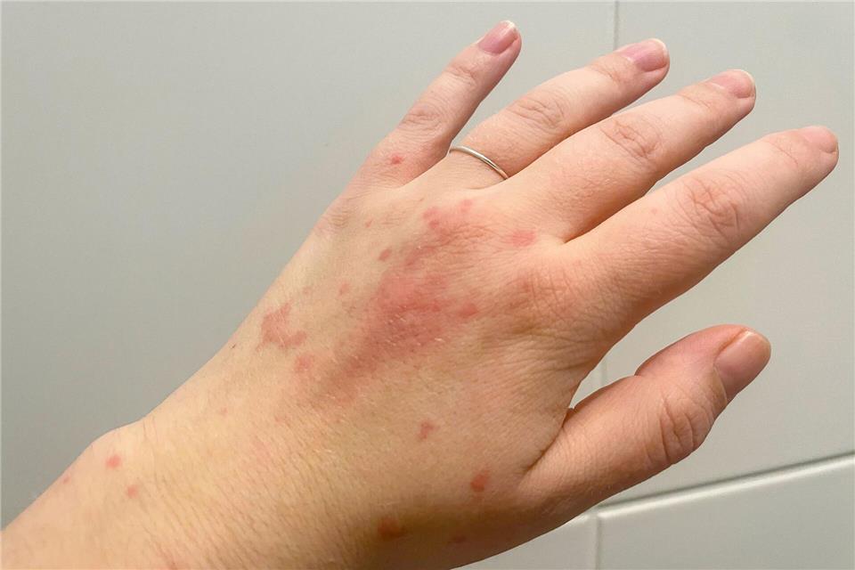 Ein Ausschlag auf der Hand - und meist nicht nur dort: Ein Nesselsucht-Schub verursacht juckende Quaddeln und Rötungen.Ricarda Dieckmann/dpa-tmn