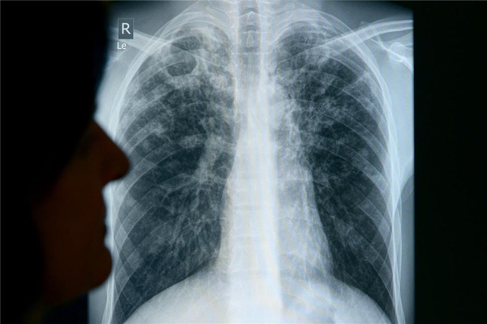 Es wurde ein weiterer Tuberkulose-Fall im Landkreis Bautzen festgestellt. (Symbolbild)Rainer Jensen/dpa