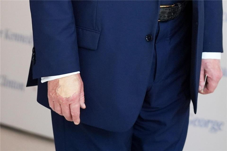 Für Trump ein unliebsames Thema: die überschminkte Hand (Archivbild).Evan Vucci/AP/dpa