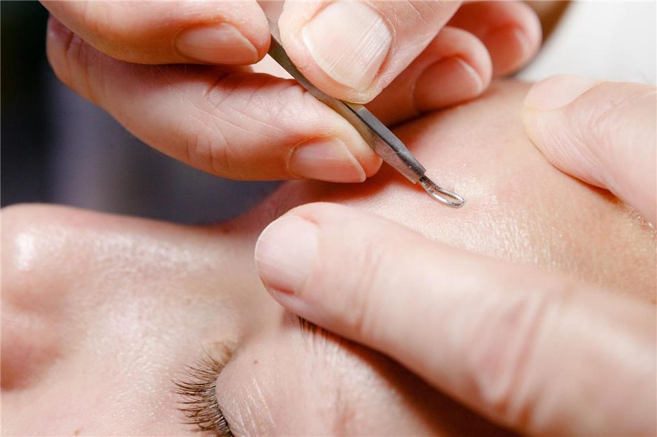 Hartnäckige Hautunreinheiten? Dann gilt: nicht darauf herumdrücken, sondern Profis ranlassen. Markus Scholz/dpa-tmn