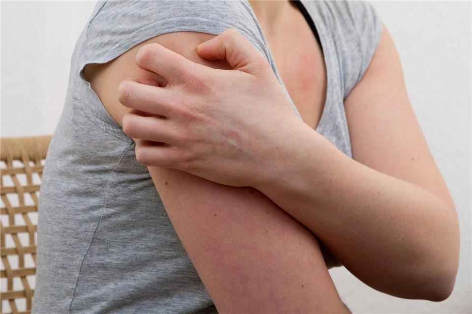 Kälte, Hitze, hormonelle Veränderungen, Infekte: Dem Auslöser einer Nesselsucht auf die Spur zu kommen, ist alles andere als einfach. Kai Remmers/dpa-tmn