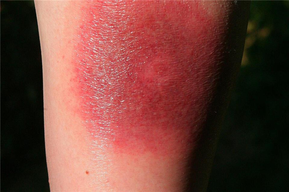 Klares Warnzeichen für Borreliose: Die sogenannte Wanderröte kann Tage oder Wochen nach einem Zeckenstich auftreten.picture alliance/dpa