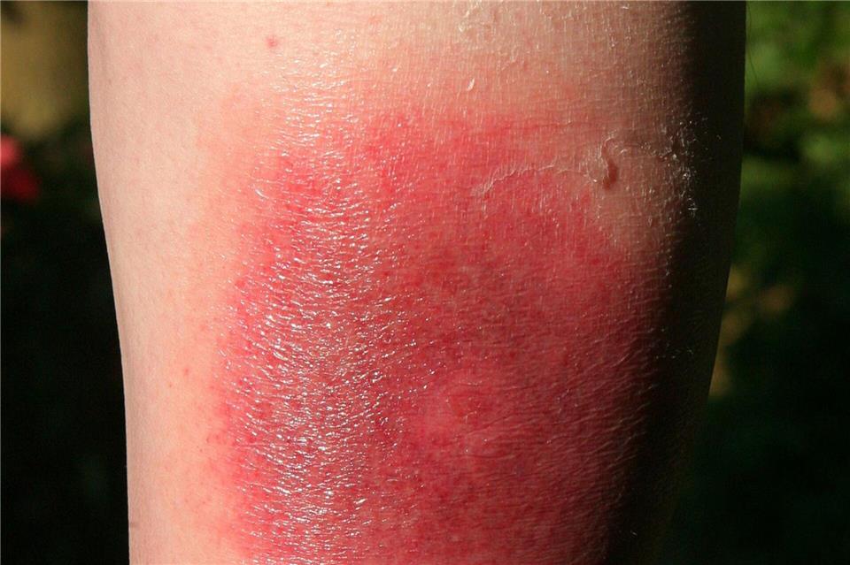 Klares Warnzeichen für Borreliose: Die sogenannte Wanderröte kann Tage oder Wochen nach einem Zeckenstich auftreten.Harry Melchert/dpa/dpa-tmn