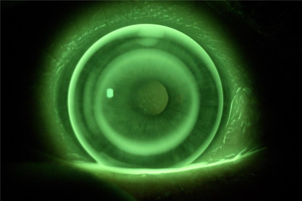 Mithilfe von Kontrastmitteln wird das Auge untersucht, um die perfekte Kontaktlinse zu finden.