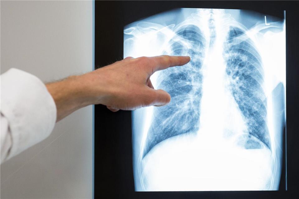 Nach einem Tuberkulose-Fall gab das Gesundheitsamt Entwarnung (Symbolbild)Silas Stein/dpa