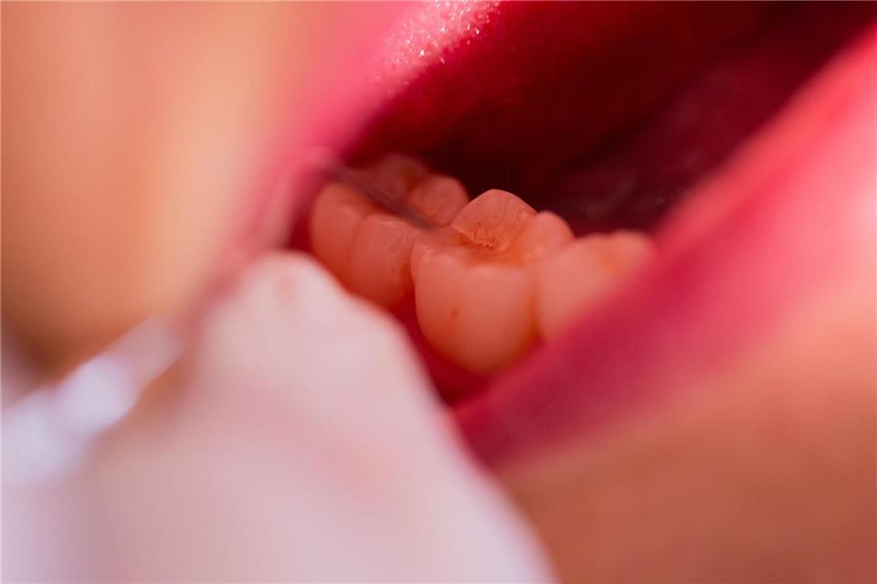 Nach einer Behandlung in einer Augsburger Zahnarztpraxis ist ein Patient gestorben. (Symbolbild)Rolf Vennenbernd/dpa