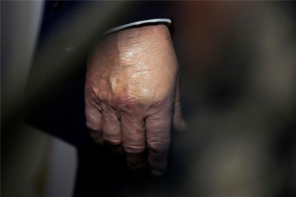 Nachdem der Bluterguss am Handrücken für Aufsehen sorgte, wurde er häufig bei Auftritten zugeschminkt. (Archivbild)Julia Demaree Nikhinson/AP/dpa
