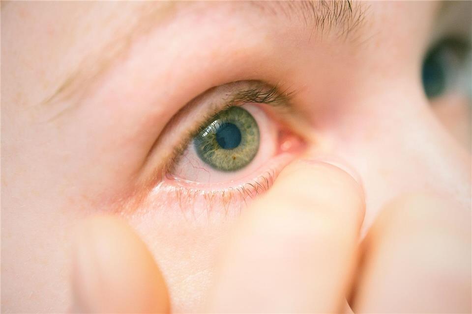 Nicht rumdrücken, lieber beraten lassen: Bei stärkerer Entzündung kann eine antibiotische Augensalbe nötig sein – abklären in Praxis oder Apotheke.picture alliance / dpa Themendienst