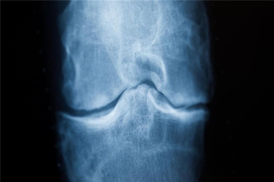 Rheuma kann sich durch Schmerzen etwa im Knie bemerkbar machen. (Archivfoto)Rolf Vennenbernd/dpa/dpa-tmn