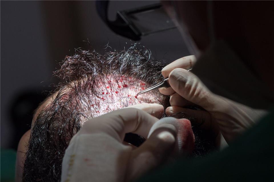 Unter bestimmten Voraussetzungen können die Kosten einer Haartransplantation steuerlich geltend gemacht werden.Andrea Warnecke/dpa-tmn