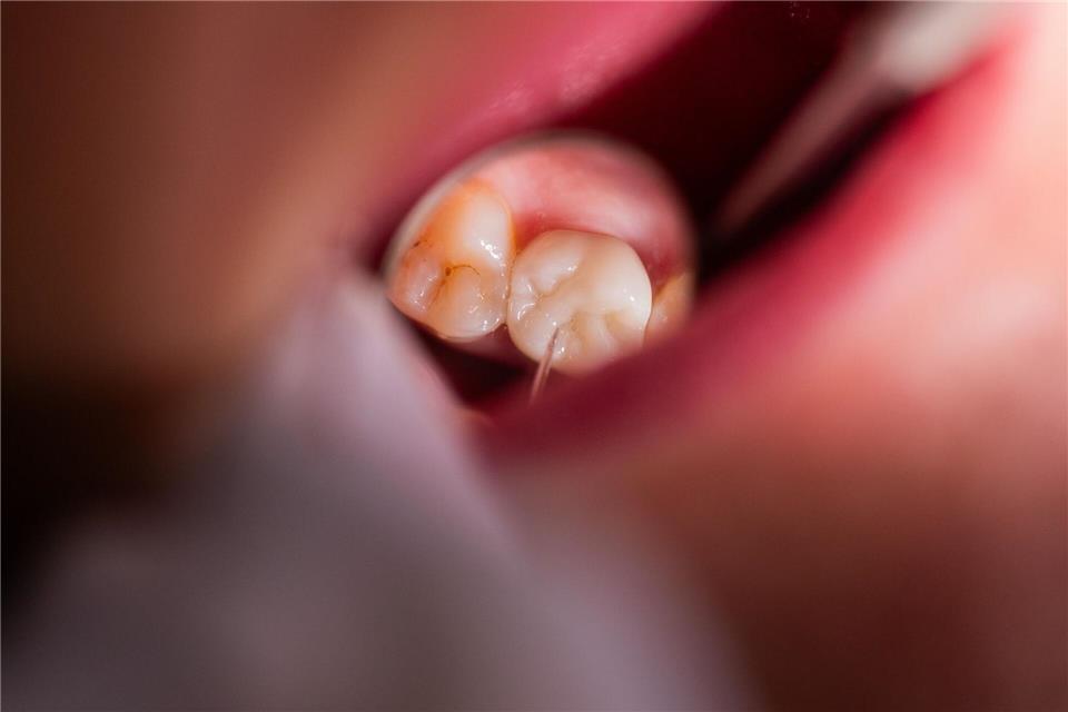 Vor allem auf dem Land fehlen in Mecklenburg-Vorpommern Zahnärztinnen und Zahnärzte. (Symbolbild)picture alliance/dpa