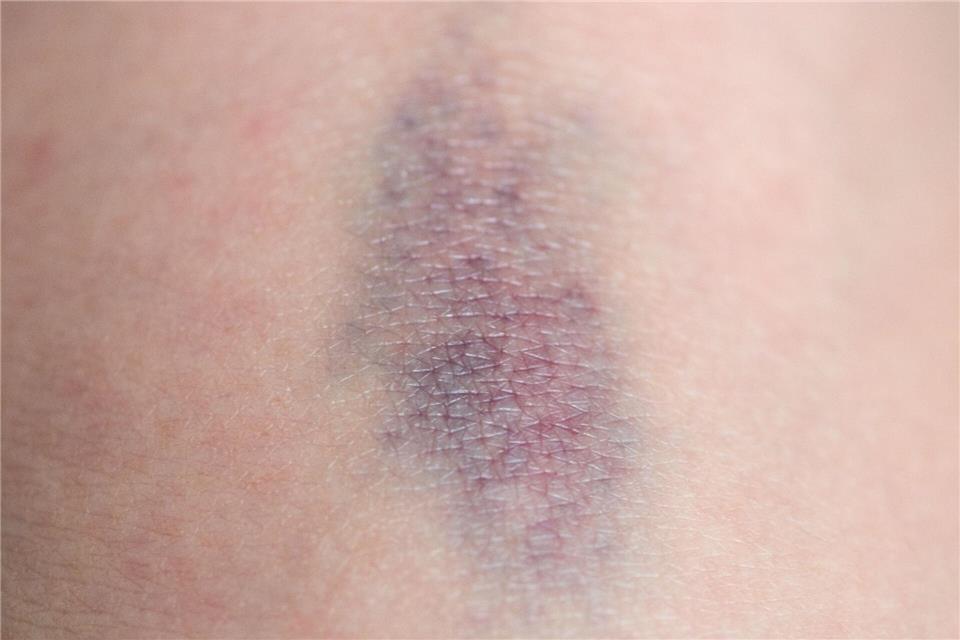 Wenn bereits leichte Stöße häufig zu blauen Flecken führen, kann das auf eine Störung der Blutgerinnung hinweisen.Andrea Warnecke/dpa-tmn