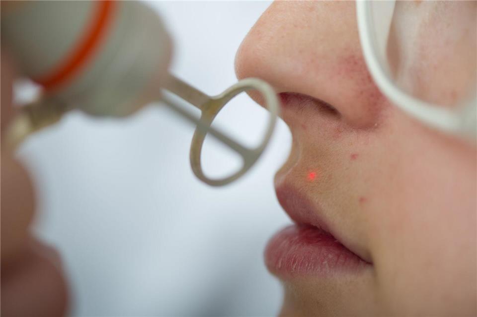 Wer sich dauerhaft von einzelnen Haaren verabschieden will, muss sie lasern lassen. Das geht aber nur bei dunklen Haaren. Uwe Anspach/dpa-tmn